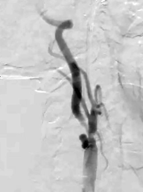 closeup of Stenosis in the right internal carotid artery